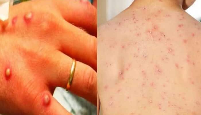 Suspected case of Monkey Pox detected in Rhode Island.